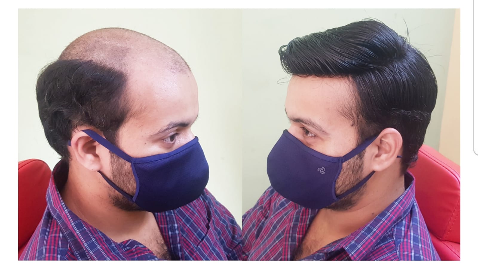 Hair Weaving in Noida | Hair Weaving Cost for Men in Noida